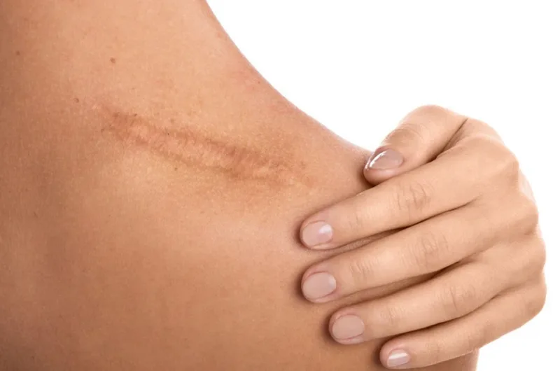 Service photo showing a healed scar on the shoulder