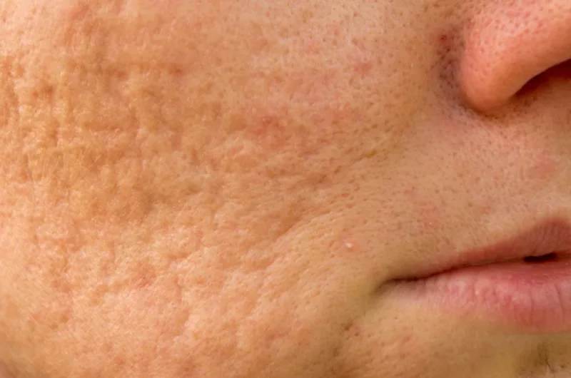 Service photo showing acne scar texture on the cheek
